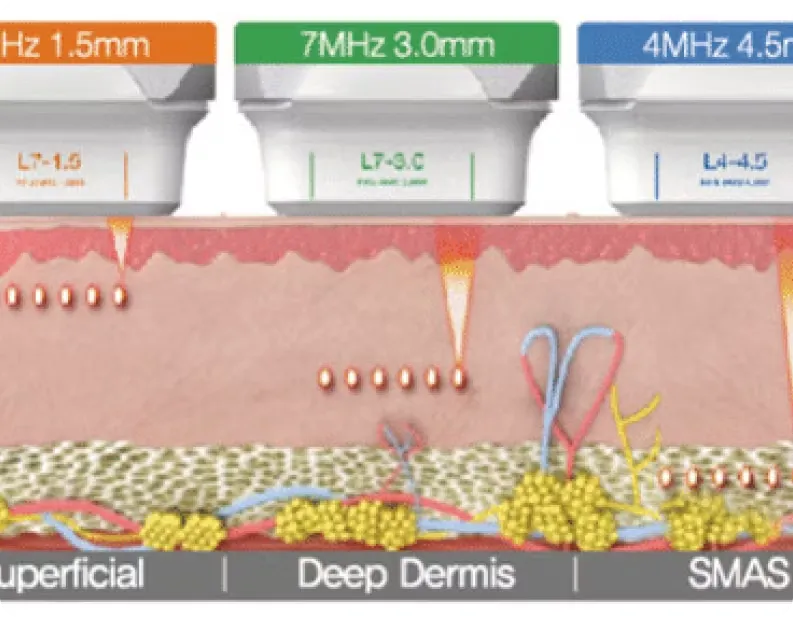 HIFU Treatment