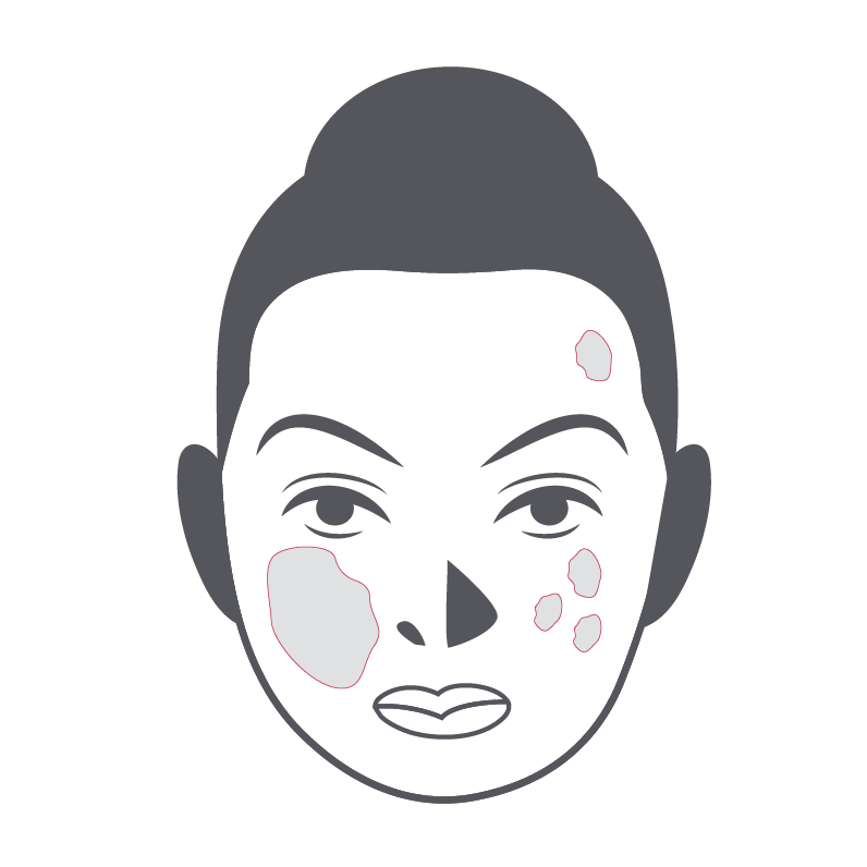 Pigmentation